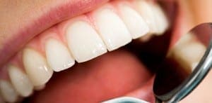 dental cleaning