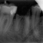 Dental Extractions