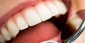 tooth discoloration